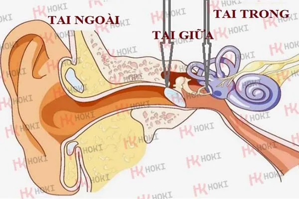 Điếc một tai do đâu? 5 biện pháp khắc phục