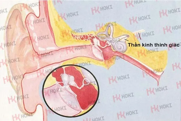 Điếc tiếp nhận: Nguyên nhân, dấu hiệu và cách khắc phục