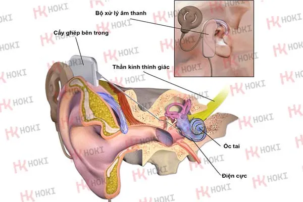 Lão thính ở người cao tuổi - 5 dấu hiệu nhận biết