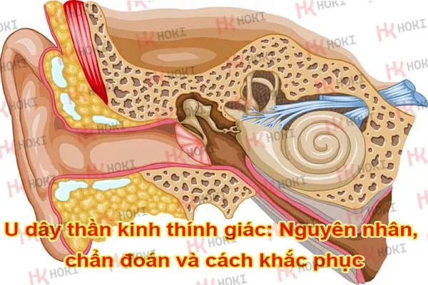 U dây thần kinh thính giác: Nguyên nhân, chẩn đoán và cách khắc phục