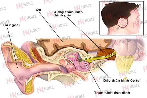 U dây thần kinh thính giác: Nguyên nhân, chẩn đoán và cách khắc phục