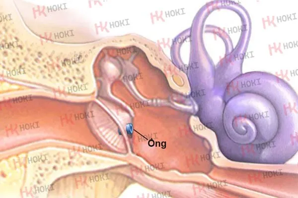 Xẹp nhĩ: Nguyên nhân,Biểu hiện và cách điều trị hồi phục